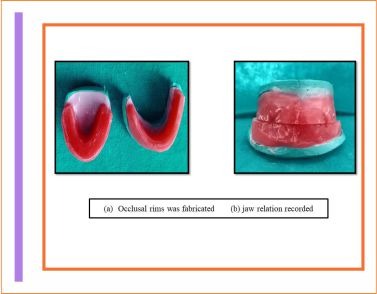 Treatment of Hypohidrotic Ectodermal Dysplasia | TMU News